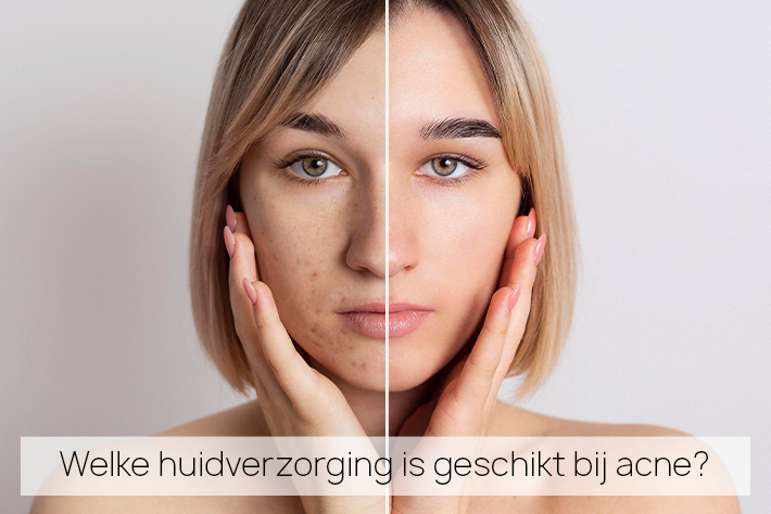 Alles Over Puistjes En Acne: Acne Behandelen En De Juiste Verzorging