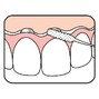 TePe Bridge & Implant Floss Multiverpakking 6x30ST reiniging gebit