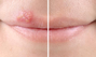 SoreFix Rescue Koortslipcrème 6ML Koortslip before/ after